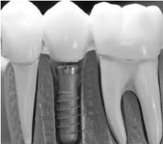 Vue d'un implant dentaire