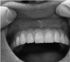 Vue de la mâchoire supérieure